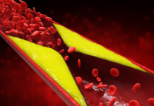 Doença arterial coronariana: Confira o que é, sintomas e tratamento