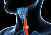 Câncer de esôfago: o que é, sintomas, causas com novas possibilidades de tratamento