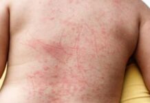 Dengue hemorrágica: como se manifesta a forma mais grave de dengue