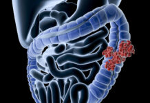 Alerta para jovens: principais causas do câncer de intestino e como prevenir