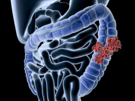 Alerta para jovens: principais causas do câncer de intestino e como prevenir