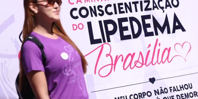 Lipedema: doença crônica vai além da questão estética Lipedema: doença crônica vai além da questão estética