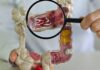Muito frequente, câncer de intestino pode não apresentar sintomas Muito frequente, câncer de intestino pode não apresentar sintomas