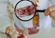 Muito frequente, câncer de intestino pode não apresentar sintomas Muito frequente, câncer de intestino pode não apresentar sintomas