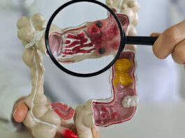 Muito frequente, câncer de intestino pode não apresentar sintomas Muito frequente, câncer de intestino pode não apresentar sintomas