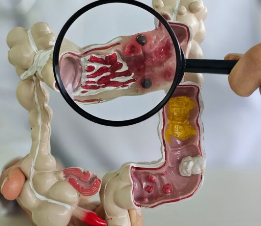 Muito frequente, câncer de intestino pode não apresentar sintomas Muito frequente, câncer de intestino pode não apresentar sintomas