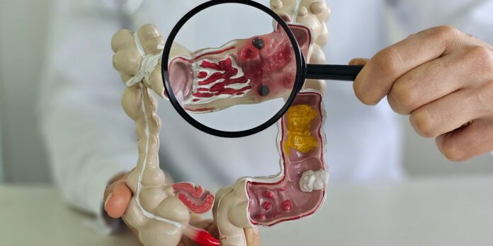 Muito frequente, câncer de intestino pode não apresentar sintomas Muito frequente, câncer de intestino pode não apresentar sintomas